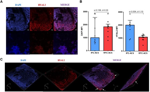 (A) Immunofluorescence analyses assessed by confocal microscopy showing DAPI and HYAL2 levels. Samples were stained with DAPI and HYAL2 antibody . Merge of the two labels is showed as composite image (co-expression of DAPI and HYAL2). Bars represent 10 μm. Images were taken at 20× magnification and at resolutions of 512 × 512. (B) Scatter plot with bars showing the DAPI and HYAL2 expressed as MFI (C) 3D representative projection of a sample of a coronary thrombus aspirated from a patient with plaque erosion created through a multiple stack series acquisition (dimension order: XYCZT). White arrows indicate the area of HYAL2 intense immunoreactivity; Wilcoxon matched-pairs signed rank test; effect size d (absolute values of d: small effect d < 0.2, medium effect d between 0.2 and 0.8, large effect d > 0.8); data are presented as median with interquartile range (IQR). DAPI, 4′,6-diamidino-2-phenylindole; HYAL2, hyaluronidase-2; mm, micrometer; MFI, mean fluorescence intensity; d = Cohen’s.