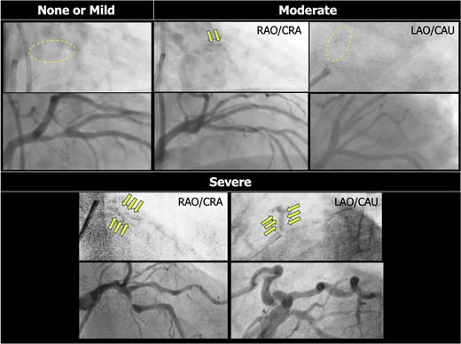 Detection of coronary calcification on invasive coronary angiography. Coronary calcification is documented as radiopaque densities in the coronary artery wall. Moderate calcification is defined as radiopaque densities noted only during cardiac motion and involving only one side of the vascular wall, which is typically visible only in a single projection. Severe calcification is defined as radiopaque densities noted without cardiac motion prior to contrast injection and involving both sides of the arterial wall. At variance, in the assessment of the SYNTAX score, severe calcification is defined as multiple persisting opacifications of the coronary wall visible in multiple projections, surrounding the complete lumen of the coronary artery at the site of the lesion.