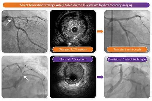 Take-home message. Select the bifurcation strategy wisely based on the left circumflex (LCx) ostium by intracoronary imaging.