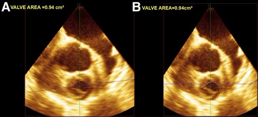 (A) An enface view of the pulmonary valve and (B) the planimetric calculation of the pulmonary valve area.