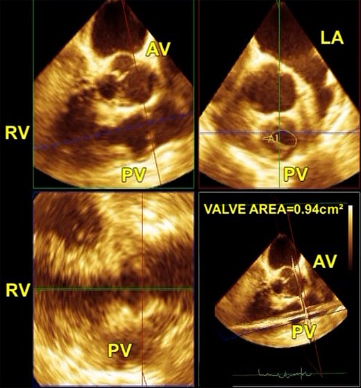 A multiplane reconstruction mode from a 3D full-volume data set to obtain the optimal en face view of the pulmonary valve area for measurement by planimetry. AV, aortic valve; LA, left atrium; PV, pulmonary valve; RV, right ventricle.