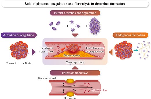 Platelet activation by exposure of plaque constituents and high shear forces, together with activation of coagulation, result in thrombus formation. This triggers simultaneous activation of endogenous fibrinolysis, and this, together with the effects of flow, may prevent vessel occlusion or restore vessel patency following thrombotic occlusion.