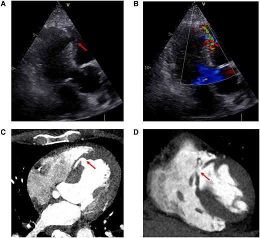 Anterior MI-VSD (arrows). (A and B) Transthoracic echocardiogram (apical long-axis view). (A) 2D echocardiography; (B) color flow Doppler. (C, D) Computed tomography scans