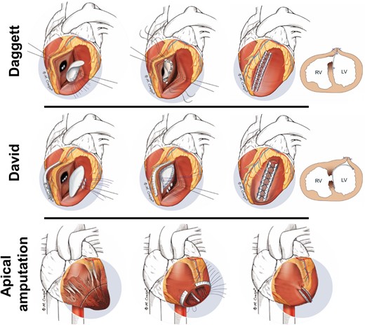 Surgical techniques of MI-VSD treatment: For mid- or basal septum MI-VSDs the ‘infarct excision’ (Daggett) and the ‘infarct exclusion’ (David) technique can be used. Ventricular apical amputation may be appropriate for apical defects