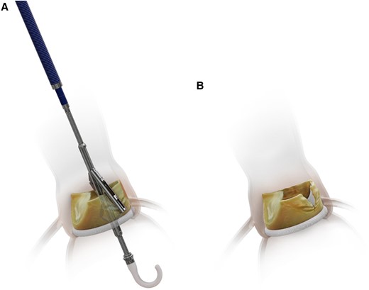 The ShortCut device. (A) The ShortCut device positioned at the bottom of the cusp with the splitting element activated. (B) Post-ShortCut split of the failed surgical valve