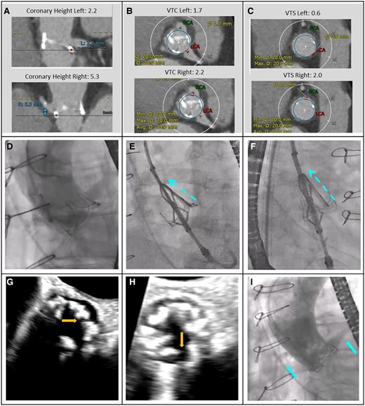 A ShortCut procedure in a patient with a failed bioprosthetic surgical valve. A 76-year-old female with a failed Magna Ease 21 mm surgical bioprosthetic aortic valve (Edwards Lifesciences) at high risk for double coronary obstruction that was treated with ShortCut and Evolut R 23 mm (Medtronic). (A–C) Computed tomography measurements showing predicted risk of coronary obstruction. (D) Baseline aortogram demonstrating risk for coronary obstruction (side view of left and right coronary cusps). (E and F) The ShortCut is positioned. Activated splitting element punctures the leaflet from the ventricular side just above the annulus. The leaflet is split by gently retracting the catheter while feeding the guidewire. (G and H) Echocardiography verifies left and right leaflet split (annotated arrows). (I) Post-TAVI implantation and ring fracture with a 23 mm True balloon (Bard) demonstrating normal coronary flow (annotated arrows). Echocardiography post-TAVI (not shown) showed aortic valve gradients of 15/6 mmHg. The patient had an uneventful hospital stay