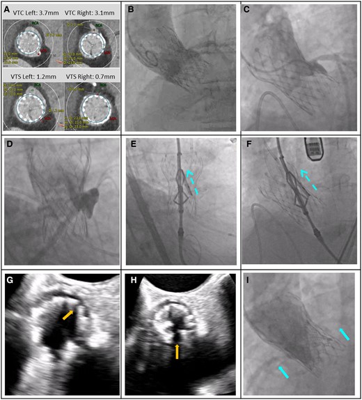 A ShortCut procedure in a patient with a failed transcatheter heart valve. A 79-year-old female with a failed Evolut R 29 mm transcatheter aortic valve (Medtronic) at high risk for double coronary obstruction due to leaflets extending well above the sinotubular junction with effaced sinuses and narrow sinotubular junction, that was treated with ShortCut and was implanted with a 23 mm SAPIEN 3 valve (Edwards Lifesciences). (A) Computed tomography measurements showing predicted risk of coronary obstruction. (B–D) Baseline aortogram, right and left coronary angiographic demonstrating of the risk for coronary obstruction (side view of left and right coronary cusps). (E and F) The ShortCut is positioned. Activated splitting element punctures the leaflet from the ventricular side just above the annulus. The leaflet is split by gently retracting the catheter while feeding the guidewire. (G and H) Echocardiography verifies left and right leaflet split (annotated arrows). (I) Post-TAVI demonstration of normal coronary flow (annotated arrows). Echocardiography post-TAVI (not shown) showed aortic valve gradients of 11/5 mmHg. The patient had an uneventful hospital stay