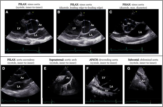 Echocardiographic imaging of the aorta at different levels. A Parasternal long-axis view of the aortic annulus, sinus of Valsalva, and sinotubular junction measured in systole using the inner-to-inner method. Measurements should be taken perpendicular to blood flow. B Parasternal long-axis view of the sinus of Valsalva and sinotubular junction measured in diastole using the leading edge-to-leading edge method. C Parasternal short-axis view of the aortic valve measured in diastole and using the largest aortic diameter. D Parasternal long-axis of the ascending aorta, measured in systole at the level of the right pulmonary artery, using the inner-to-inner method. E Suprasternal view of the aortic arch measured in systole between the truncus brachiocephalicus and the left carotid artery, using the inner-to-inner diameter. F Modified apical two-chamber view of the descending aorta measured at the level of the left atrium in systole using the inner-to-inner method. G Subcostal view of the abdominal aorta at the level of the liver, measured in systole using the inner-to-inner diameter. Ao, aorta; AP2CH, apical two-chamber view; LA, left atrium; LV, left ventricle; PSLAX, parasternal long-axis view; PSSAX, parastenal short-axis view