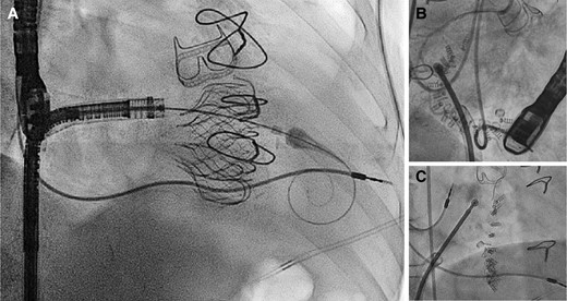 Examples of lead jailing during trancatheter tricuspid valve interventions. Examples of pacemaker lead jailing during transcatheter valve replacement with the EVOQUE system (A) and direct transcatheter tricuspid annuloplasty with the Cardioband system (B and C). In both cases, no lead dysfunction was detected up to 2 years after the procedure.