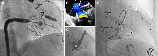 Examples of valve-sparing pacing strategies in the context of transcatheter tricuspid valve replacement. (A) Pre-emptive implantation of a LCPM before transcatheter tricuspid valve replacement with the EVOQUE system in a patient with a complete atrioventricular block during right heart catheterization. The position of the LCPM needs to be carefully chosen; (B) transoesophageal echocardiography guiding of coronary sinus lead implantation (white arrow) after transcatheter tricuspid valve replacement with the LUX valve; (C) sinus angiography highlighting potential interaction between the bioprosthesis and the coronary sinus; and (D) final pacemaker lead (white arrow) placement into the coronary sinus. CS, coronary sinus.