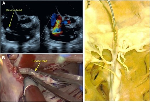 Surgical situ in a patient with lead-related tricuspid regurgitation. (A) Device lead attached to the tricuspid valve in echocardiography; (B) intra-operative view of an attached cardiac implantable electronic device lead; and (C) device lead attached to the tricuspid valve and the subvalvular apparatus with significant ingrowth.