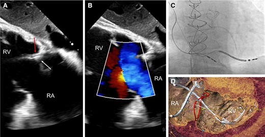 Example of a lead-related tricuspid regurgitation with ‘tricuspid kick’ and impingement of the posterior leaflet. Severe lead–leaflet interaction with impingement of the posterior leaflet resulting in severe cardiac implantable electronic device-related tricuspid regurgitation. (A) Impingement of the posterior leaflet; (B) severe tricuspid regurgitation with large coapation gap and secondary leaflet tethering; (C) excessive slack with visible tricuspid kick as a sign of potential interaction with the tricuspid annulus; and (D) cardiac computed tomography shows interaction with the tricuspid valve annulus (reconstructed line), as well as excessive slack in the right ventricle. RA, right atrium; RV, right ventricle.