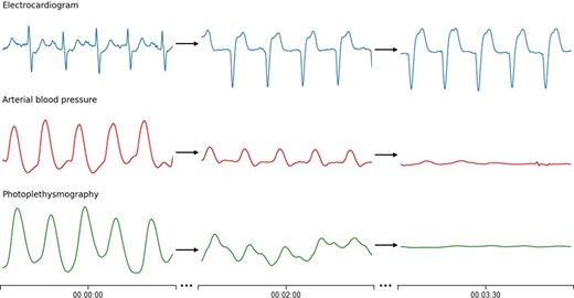 Episode of spontaneous cardiac arrest