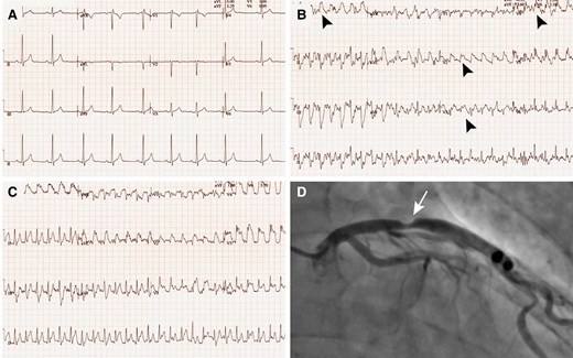 Case presentation of a 44-year-old previous Tour de France cyclist with chest pain and abnormal exercise stress test. Resting 12-lead electrocardiogram (A), electrocardiogram during exercise (B), and early recovery (C) showing manifest ST-segment elevation (black arrowheads) in leads V2–V6 and leads I and aVL. (D) Coronary angiogram with a significant proximal left anterior descending lesion (white arrow)