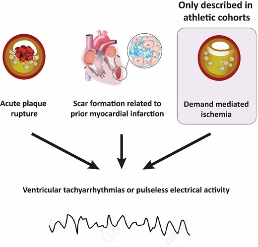 Mechanisms of sports-related sudden cardiac death due to coronary artery disease.79–81 Demand ischaemia is a recognized mechanism for ventricular arrhythmias and/or sudden cardiac death in athletes, driven by the myocardium’s work/metabolic requirements during intense exercise