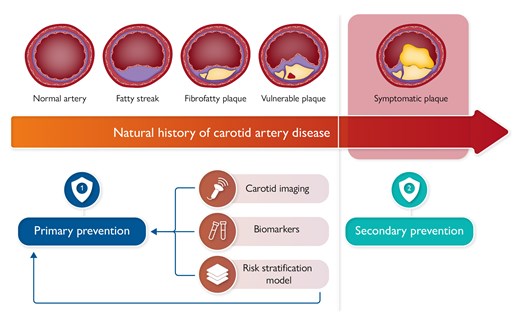 The progression of carotid atherosclerotic plaque, from a normal carotid wall to symptomatic plaque. Non-invasive imaging modalities, circulating biomarkers, and risk stratification instruments may alter this natural history.