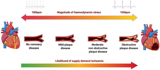 Evaluation of the ischaemic threshold. The magnitude of haemodynamic stress and burden of coronary atheroma influence the likelihood of supply–demand ischaemia and type 2 myocardial infarction. A patient without coronary artery disease requires a significant haemodynamic stressor to result in supply or demand imbalance compared to a patient with obstructive coronary artery disease. This illustration considers coronary disease in isolation for simplicity, but in practice, multiple competing aetiologies contribute