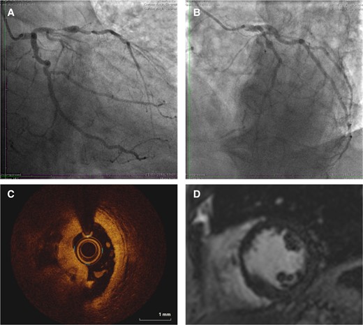 Illustrative case example of patient with clinical diagnosis of type 2 myocardial infarction where the use of invasive coronary angiography and optical coherence tomography led to diagnostic reclassification. A 64-year-old presents with increasing ischaemic sounding chest pain, with fever, breathlessness, and cough for 2 days. The admission observations were heart rate 114, oxygen saturations 93% on 4L, respiratory rate 34, temperature 38.9 °C, and blood pressure 156/78. The electrocardiogram demonstrates a presumed new left bundle branch block. A chest X-ray demonstrates right lower lobe consolidation with a C-reactive protein 160 ng/L. The peak high-sensitivity cardiac troponin I was 6451 ng/L. This was treated as type 2 myocardial infarction. Coronary angiography demonstrated a severe lesion in the proximal left anterior descending artery with collaterals to an occluded right coronary artery (A and B) with intracoronary plaque rupture and thrombosis in the left anterior descending artery on optical coherence tomography (C), and corresponding basal anteroseptal late gadolinium enhancement on cardiac magnetic resonance imaging scan (D). The diagnosis was reclassified as type 1 myocardial infarction. Reproduced with permission from the DEMAND-MI educational resource with identifiable features changed77