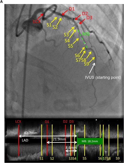 Panel A contains a composite image showing a coronary angiogram and longitudinal IVUS reconstruction mapping a myocardial bridge in the LAD artery. The image show the location of the MB in relation to diagonal (D1–D3) and septal (S1–S9) branches. Panel B shows examples of arterial compression, maximum plaque burden and halo thickness on IVUS.