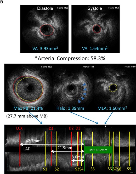 Panel A contains a composite image showing a coronary angiogram and longitudinal IVUS reconstruction mapping a myocardial bridge in the LAD artery. The image show the location of the MB in relation to diagonal (D1–D3) and septal (S1–S9) branches. Panel B shows examples of arterial compression, maximum plaque burden and halo thickness on IVUS.