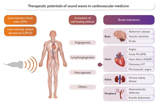 Therapeutic potentials of sound wave therapies with shock wave (SW) and low-intensity pulsed ultrasound (LIPUS). The SW and LIPUS therapies could activate self-healing abilities depending on disease-specific conditions, including angiogenesis in ischaemic tissue, lymph-angiogenesis in oedematous tissue, neurogenesis in damaged nervous tissue, and others. These sound therapies appear to have broad indications for the brain, heart, kidney and peripheral arteries in cardiovascular medicine. AMI, acute myocardial infarction; HFpEF, heart failure with preserved LV ejection fraction.