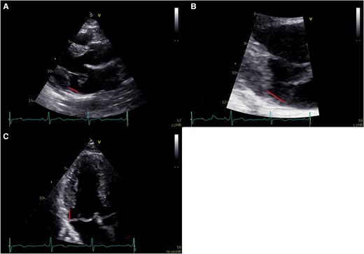 Assessment of mitral annular disjunction by transthoracic echocardiography. (A) Transthoracic echocardiographic parasternal long-axis image demonstrating mitral annular disjunction with mitral valve prolapse near ventricular end systole; (B) transthoracic echocardiographic long-axis zoomed image demonstrating mitral annular disjunction; and (C) transthoracic echocardiographic apical three-chamber view demonstrating mitral annular disjunction with mitral valve prolapse near ventricular end systole