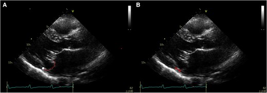Assessment of pseudo-mitral annular disjunction by transthoracic echocardiography. (A) and (B) Pseudo-mitral annular disjunction. The white point marks the hinge line. The dotted line marks the posterior leaflet. If the annular plane is erroneously set at the leaflet bending point in the atrium, then pseudo-mitral annular disjunction occurs (double dotted arrow)