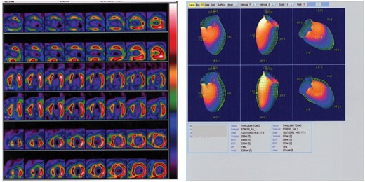 Myocardial perfusion scintigraphy and left ventriculography showing dilated left ventricle with left ventricular ejection fraction 19%. Reversible perfusion defects on the antero-septal wall and fixed apical perfusion defect.