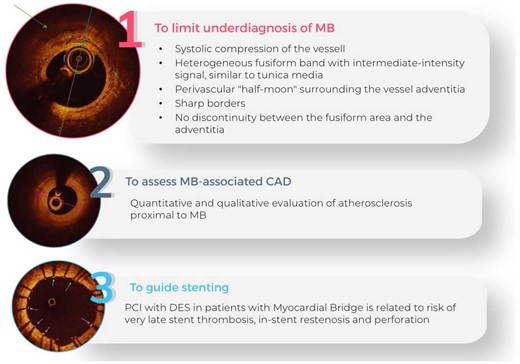 Role of optical coherence tomography in myocardial bridge-assessment. OCT, optical coherence tomography; MB, myocardial bridge; CAD, coronary artery disease; PCI, percutaneous coronary intervention; DES, drug eluting stent.