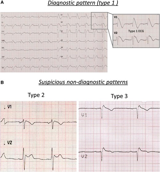 Brugada electrocardiographic patterns: (A) diagnostic pattern (type 1) and (B) suspicious pattern (type 2, left panel; type 3, right panel).