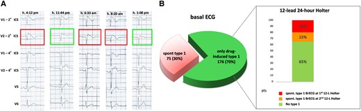 12-lead 24-h Holter monitoring in patients with Brugada electrocardiographic pattern: (A) intra-daily fluctuations of the electrocardiographic pattern, oscillating between diagnostic type 1 (1st, 3rd and 4th strip) and suspicious non-diagnostic patterns (2nd and 5th strip); (B) role of 12-lead Holter monitoring in unmasking spontaneous diagnostic type 1 pattern in patients originally presenting with drug-induced only type 1 pattern (adapted from Cerrato et al.12).