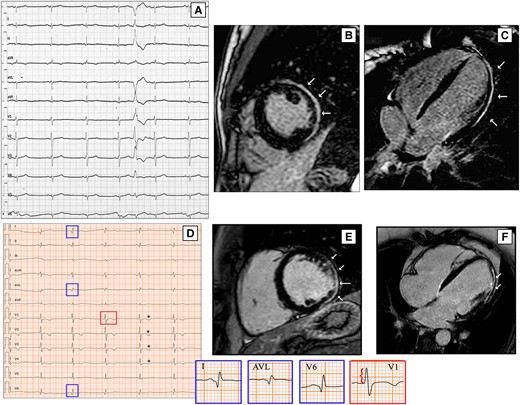 ECG findings of two DCM patients with LGE on CMR. ECG performed in 21-year-old woman shows low QRS voltages in V4–V6, LPFB, with AQRS ≈ + 120° and a premature ventricular beat with RBBB morphology and right axis deviation suggesting an origin in the LV lateral wall (A). On CMR, LGE involves the sub-epicardial lateral wall (B and C, white arrows). A 41-year-old man with a history of ventricular arrhythmias and ventricular dysfunction shows on ECG pathological lateral q waves (D, blue boxes), tall R wave in V1 (red box), and anterior T wave inversion (asterisks); his CMR reveals biventricular dilation and a stria LGE pattern with sub-epicardial distribution, mainly involving the LV lateral wall (E and F, white arrows). CMR, cardiac magnetic resonance; DCM, dilated cardiomyopathy; LGE, late gadolinium enhancement; LPFB, left posterior fascicular block; LV, left ventricular; RBBB, right bundle branch block.
