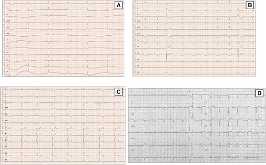 ECG findings of DCM patients with arrhythmic genotypes. First ECG evidence of asymptomatic slow atrial fibrillation in 48 years-old female with a familiar history of SCD carrying likely pathogenic mutation in LMNA gene (A). Basal ECG of a 33 years-old man with a missense mutation in LMNA gene (p.Arg190Trp) displays signs of septal remodelling, such as pathological Q waves in leads V1–V4, poor R-wave progression (R wave <3 mm) in leads V1–V3 and QRS fragmentation. Extremely low QRS voltages in precordial leads, diffuse flat T waves, premature ventricular beats with LBBB, and inferior axis morphology are also present (B). A 51-year-old man with FLNC mutation and familiar history of DCM shows on ECG negative TWI in infero-lateral leads (C). ECG performed in 61-year-old man with a PLN p.Arg14del mutation. The ECG shows very low QRS voltages in limb leads, flat T waves, and poor R wave progression in precordial leads (D). DCM, dilated cardiomyopathy; FLNC, filamin C; LBBB, left bundle branch block; LMNA, lamin A/C; LV, left ventricular; PLN, phospholamban; SCD, sudden cardiac death; TWI, T wave inversion.