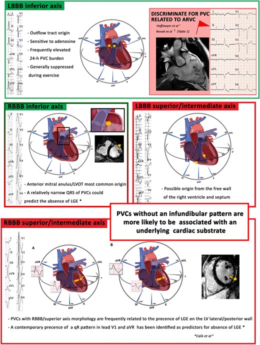Representative monomorphic premature ventricular complexes, except for the fascicular pattern. The figure shows the main morphologies of premature ventricular complexes and their sites of origin. Green boxes indicate morphologies associated with a lower risk of structural heart disease. The left bundle branch block inferior axis morphology generally indicates an origin from the outflow tract of the right/left ventricle but rarely can be the expression of a predominantly arrhythmogenic right ventricular cardiomyopathy; the electrocardiographic characteristics that can help discriminate a structural cardiomyopathy (arrhythmogenic right ventricular cardiomyopathy) are indicated in Table 1. The right bundle branch block inferior axis morphology instead indicates an origin from the outflow tract of the left ventricle or from the mitral annulus; the duration of the QRS in this case can discriminate the presence/absence of late gadolinium enhancement at cardiac magnetic resonance. The red boxes are highly indicative of structural heart disease, therefore worthy of further diagnostic investigations. A left bundle branch block superior axis morphology could be indicative of an origin from the free wall of the right ventricle or from the mid-ventricular septum. A superior axis right bundle branch block morphology, suggesting a left ventricular origin, are more often associated with scar at CMR. Panel A shows how the depolarization forces can give rise to an initial Q wave in avR and V1 in the absence of scar; Panel B, instead, shows how the presence of scar gives rise to a depolarization gradient mainly directed towards leads V1 and aVR; no Q waves showed at 12-lead electrocardiogram.