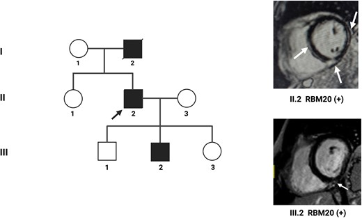 An example of familial dilated cardiomyopathy. A 56-year-old patient (II.2) is referred for frequent ventricular extrasystole. On the echocardiogram, dilated cardiomyopathy with moderate systolic dysfunction and left ventricular ejection fraction of 40% is diagnosed. Cardiac magnetic resonance imaging with contrast highlights numerous areas of late gadolinium enhancement at the level of the interventricular septum, the lateral wall, and the junction between the interventricular septum and the right ventricle (white arrows). Genetic analysis reveals a pathogenetic variant of the RBM20 gene. Family screening highlights mild dilatation of the left ventricle in the male child (III.2). Cardiac magnetic resonance imaging shows a small area of late gadolinium enhancement at the junction between the interventricular septum and the right ventricle (white arrow). Genetic analysis shows the same pathogenetic variant on the RBM20 gene detected in the father.