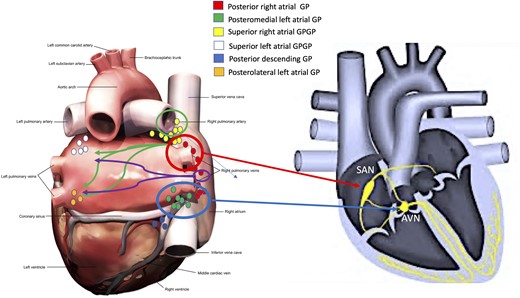 Location of the main atrial ganglionated plexi (A) according to Armour’s anatomical studies9 and (B) influence on the function of the atrioventricular node (see arrows) and sino-atrial node (see arrows). Also, neural interconnections between the right and left atrial main ganglionated plexi were noted (see arrows directed from right to left atrium). AVN, atrioventricular node; GP, ganglionated plexi; SAN, sino-atrial node.