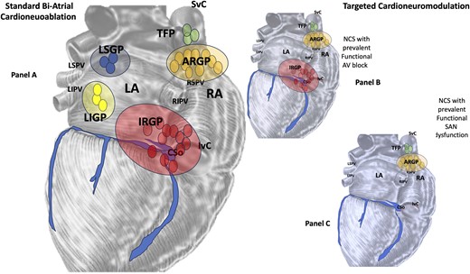 (A) Bi-atrial standard cardioneuroablation: an endocardial vagal denervation methodology based on the identification (by Fast Fourier Transformation) of fragmented signals in the (left and right atrium, respectively), markers of the neuro-myocardial interface (fibrillar myocardium), where parasympathetic fibres are located in the context of the atrial wall compact myocardium. (B) and (C) ‘Cardioneuromodulation’ could be more appropriate when considering an ablative non-extensive and personalized procedure according to different clinical settings. LA, left atrium; RA, right atrium; SVC, superior vena cava; IVC, inferior vena cava; RSPV, right superior pulmonary vein; RIPV, right inferior pulmonary vein; LSPV, left superior pulmonary vein; LIPV, left inferior pulmonary vein; TFP, third fat pad; IRGP, inferior right ganglionated plexi; ARGP, anterior right ganglionated plexi; LSGP, left superior ganglionated plexi; LIGP, left inferior ganglionated plexi.