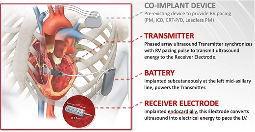 WISE® CRT System