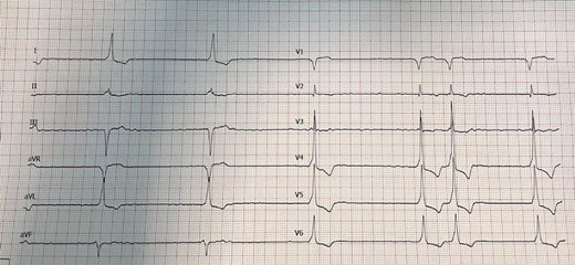 AF complicated with complete AV block, in addiction wide QRS with low amplitude delta wave.
