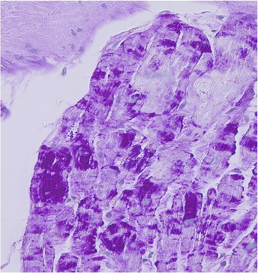 x40. Zonal pathological glycogen accumulation in myocardiocytes detected by periodic acid-Schiff (PAS) staining.