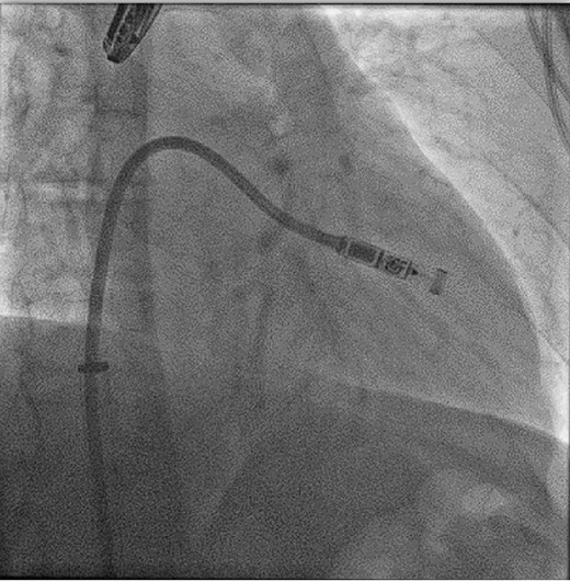 Femoral implantation of a Micra VR (right anterior oblique projection 35°), ©Miguel A. Leal, MD.