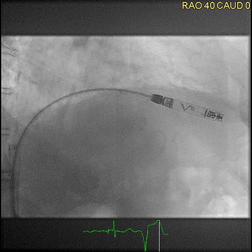 Femoral implantation of an Aveir VR (right anterior oblique projection 40°), ©Clemens Steinwender, MD.
