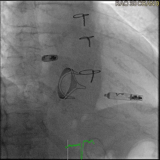 Aveir DR leadless pacemaker system after implantation (right anterior oblique projection 30°), ©Clemens Steinwender, MD.