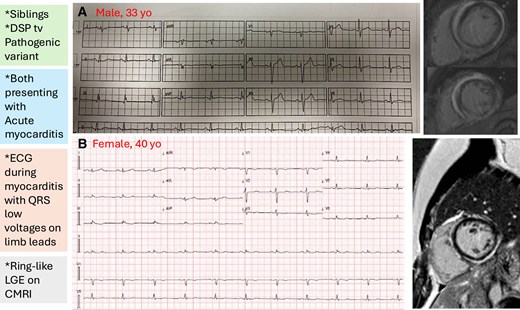 Alt text: Image illustrating the electrocardiograms of two brothers carrying a truncated pathogenic variant of the desmoplakin gene who present with acute myocarditis, with evidence of low QRS voltages in the peripheral leads. Cardiac magnetic resonance images show ring-like late gadolinium enhancement.