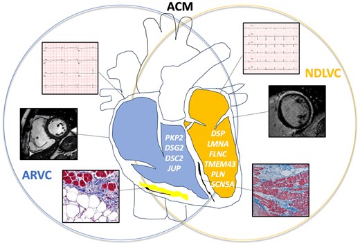 Alt text: Venn diagrams showing the instrumental (electrocardiogram, CMR, endomyocardial biopsy) and genetic overlap between ARVC and NDLVC.