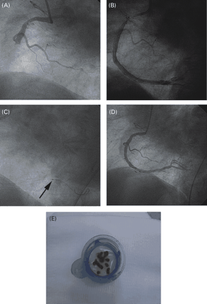 Figure 1 Primary PCI in patient with inferior ST elevation acute myocardial infarction. (A) Right coronary artery: angiography after a few balloon catheter inflations (balloon 4.0×20 mm)—TIMI grade 0 flow. Restoration of flow not possible with standard PCI technique in the infarct-related artery. (B) Angiography after first passage of thrombectomy device (Diver CE)—restoration of flow. Huge residual thrombus visible especially in the proximal and distal right coronary arteries. (C) Continuous aspiration in very distal part of the right coronary artery—visible marker on tip of the thrombectomy catheter (arrow). (D) Angiography performed after thrombectomy and final stent implantation (stent 4.5×15 mm in mid-segment of right coronary artery)—TIMI grade 3 flow in infarct-related artery. (E) Large thrombus and debris retrieved from the right coronary artery by thrombectomy device.