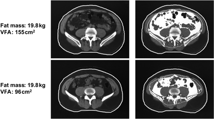 CT scans from two subjects with comparable BMI illustrating adiposity phenotypes characterized mainly by intra-abdominal adiposity (top panels) and subcutaneous adiposity (bottom panels). Subcutaneous fat is shown in black under the skin, and visceral fat area (VFA) in white. Scans were made at the L4-L5 level. Reproduced with permission from Tchernof A, Després JP. Obesity and lipoprotein metabolism. In: Kopelman PG, ed. Clinical Obesity, UK: Blackwell Science Ltd; 1998. p176–204.