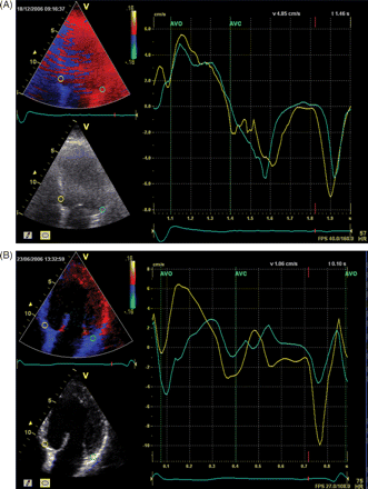 Colour-coded tissue Doppler imaging in the apical four-chamber view. The myocardial velocity curves are derived from sample volumes that are placed off-line in the basal septum and the basal lateral wall (arrows indicate peak systolic velocities, E' and A' represent diastolic parameters). (A) Example of a patient without a time delay in peak systolic velocity between the septum and the lateral wall, indicating absence of left ventricular dyssynchrony. (B) Example of a patient with substantial left ventricular dyssynchrony between the peak systolic velocity of the septum (first arrow) and the lateral wall (second arrow).