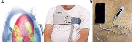 (A) Remote dielectric sensing technology (Sensible Medical Innovations Ltd, Netanya, Israel) assesses lung congestion using electromagnetic-based technology. (B) Handheld ultrasound, V-scan (GE Healthcare).