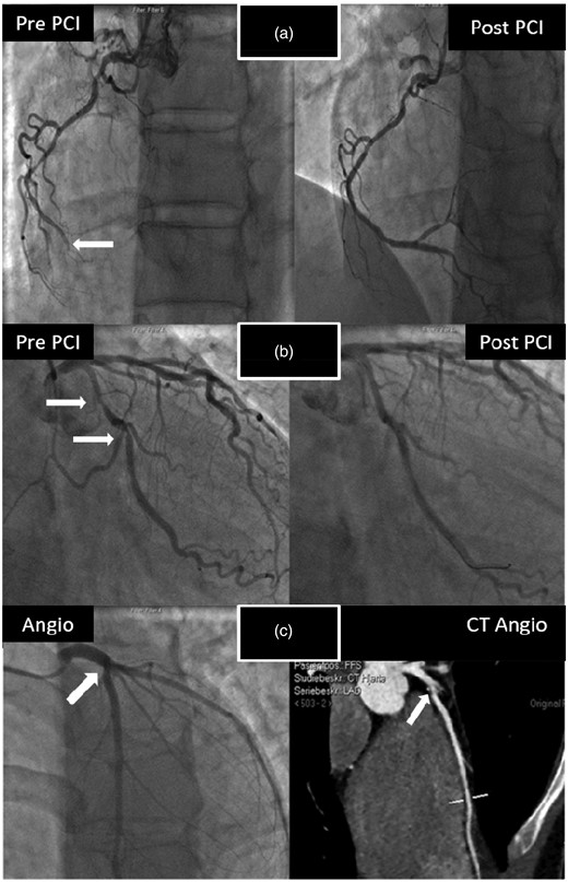 Coronary angiograms and computed tomographic (CT) coronary angiography in the three presumably healthy male cyclists with coronary artery disease (CAD) participating in a 91 km mountain bike race (‘Nordsjørittet’) 2013. All three were experienced competitive leisure-sports athletes that had participated in ≥ 5 endurance competitions during the past five years. None of them had symptoms of CAD during or after the race and there were no changes in the rest electrocardiograms (ECGs) suggestive of ischaemia at any time-point. The first cyclist had the largest increase in cardiac troponin I (cTnI) of all participants in the study; with a substantial increase in cTnI at 3 h with a continued increase at 24 h. Coronary angiography demonstrated a significant left anterior descending (LAD) artery stenosis and an occluded right coronary artery (white arrow) that was revascularised by percutaneous coronary intervention (PCI) (Figure 2(a)). The second cyclist's highest cTnI value 24 h following the race. Coronary angiography demonstrated stenosis of the proximal portion of the circumflex artery (white arrows, Figure 2(b)). The third cyclist was a 22-year-old male with highest cTnI value recorded 3 h following the race. CT coronary angiography detected a ruptured and calcified plaque in the proximal portion of the LAD (white arrow), later confirmed by coronary angiography (Figure 2(c)).